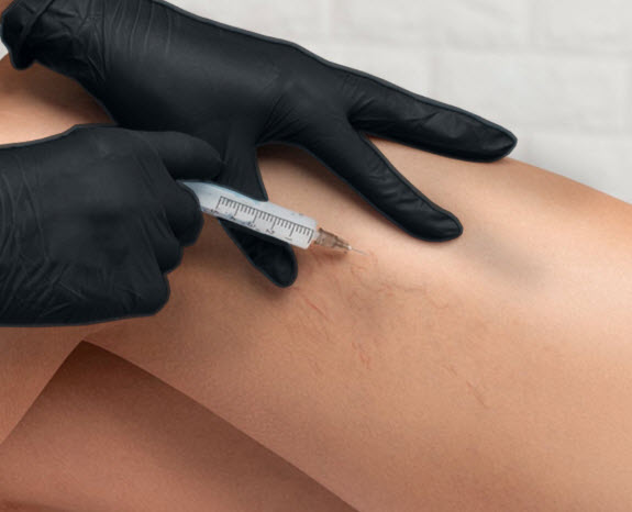 Sclerotherapy