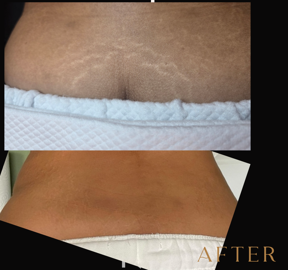STRETCHMARK AND SCAR REVISION
