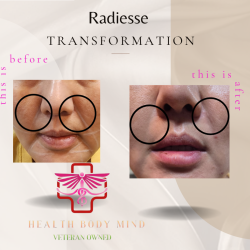 Collagen Biostimulator