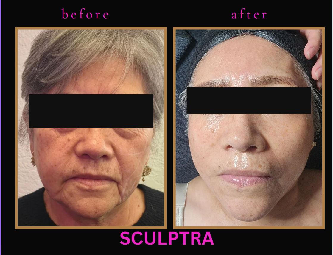 Collagen Biostimulator