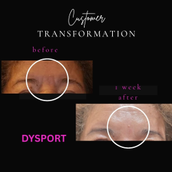 Neurotox (Xeomin,Dysport,Daxxify)
