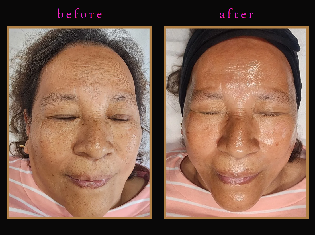 Hydrafacial