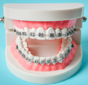 Metal Braces