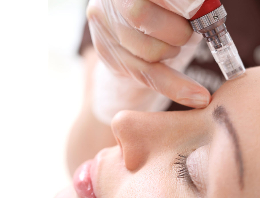 Micro-needling with PRF Treatments 