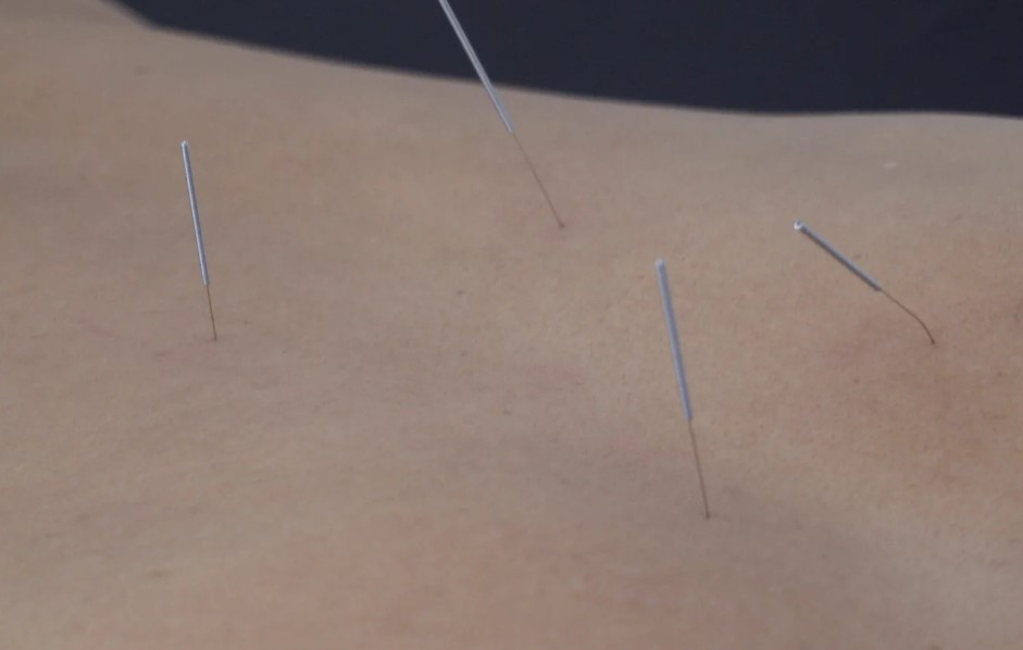 Dry Needling Therapy