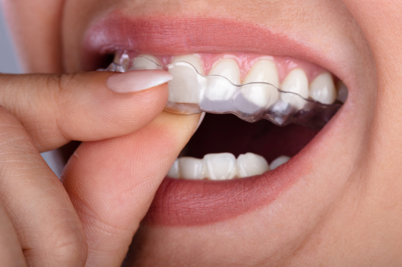Clear Aligners