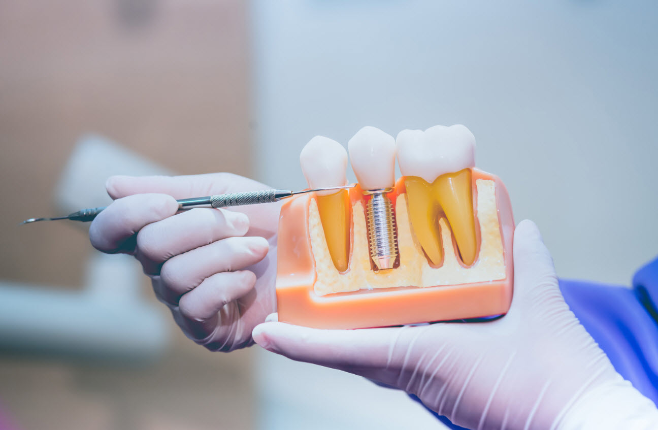 Dental Implants