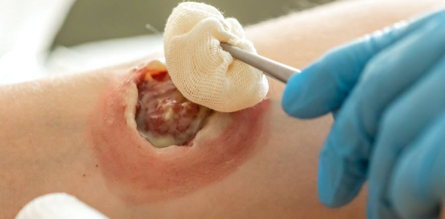 Surgical and Trauma-Related Wounds