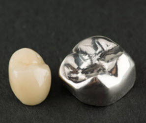 PFM Crowns/Bridges