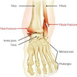 Ankle of Foot Fractures