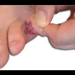Skin Infections