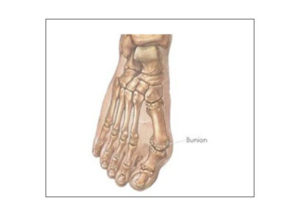 Bunions
