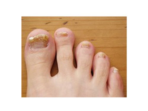 Nail fungus