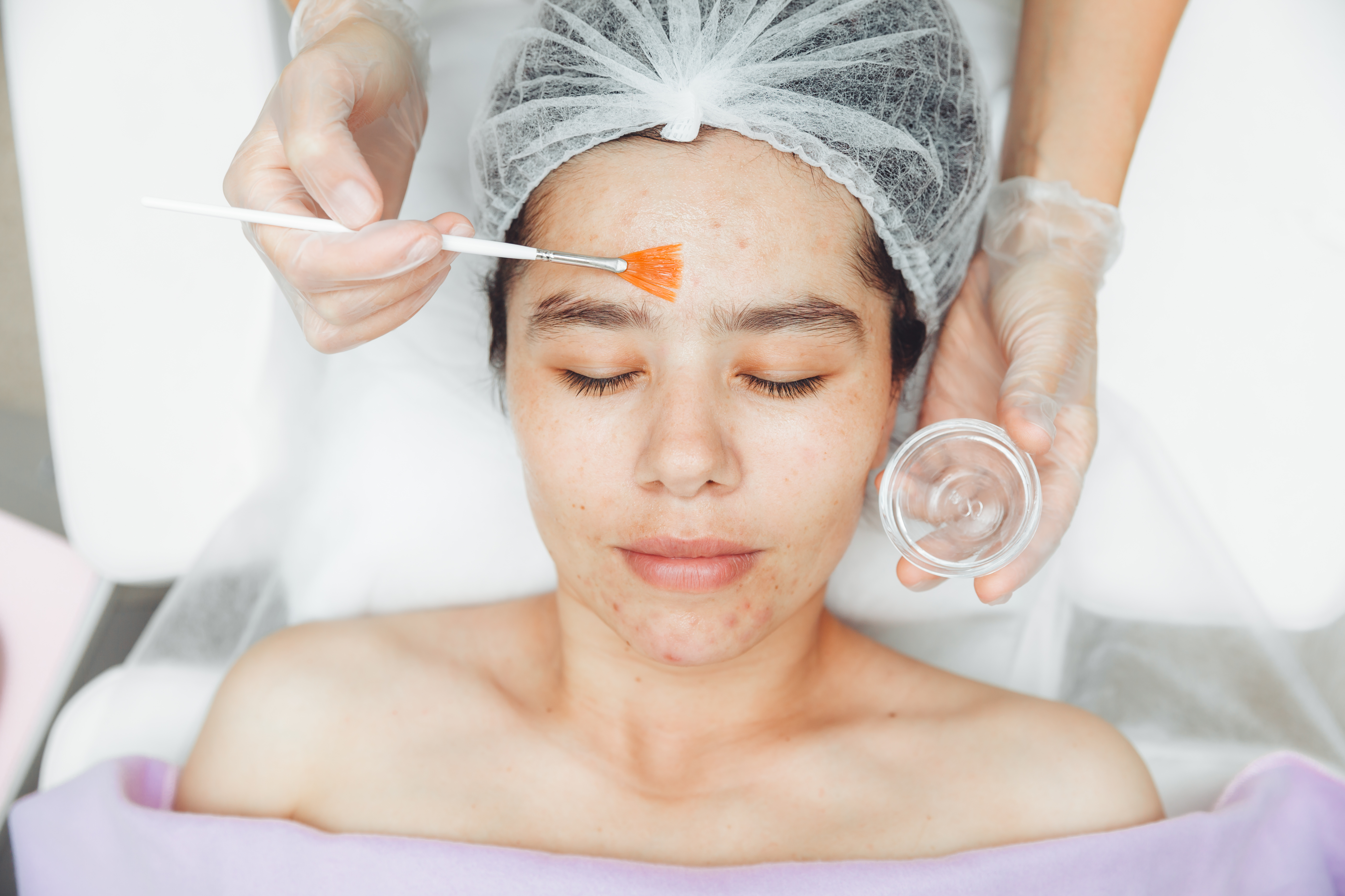Acne Facial