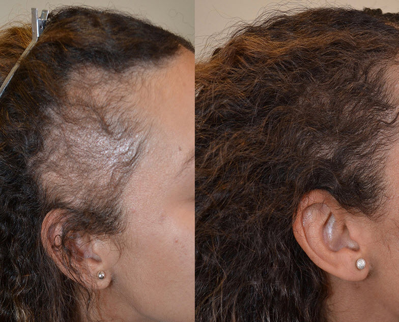Platelet-Rich Plasma (PRP) Hair Loss Sessions