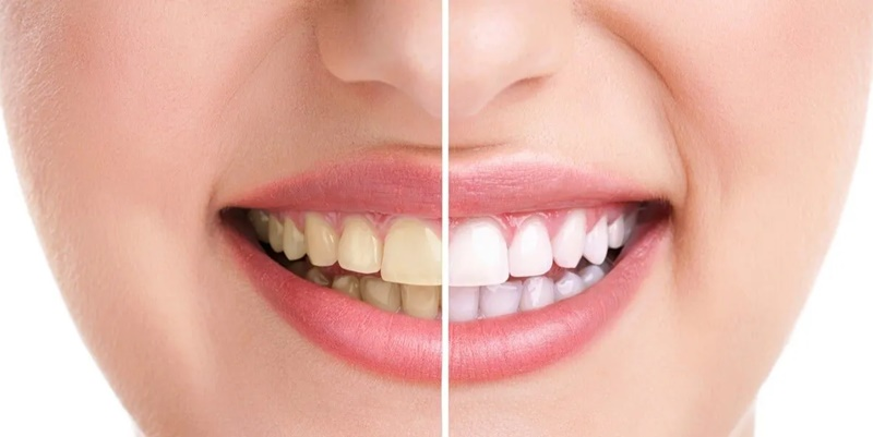 Tooth Whitening