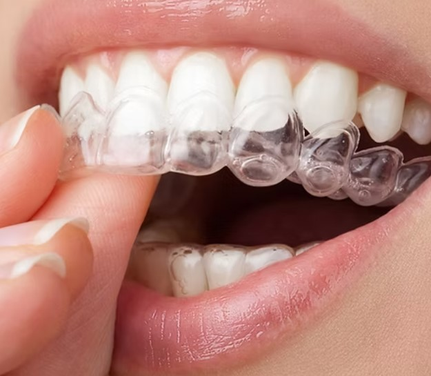 Aligners