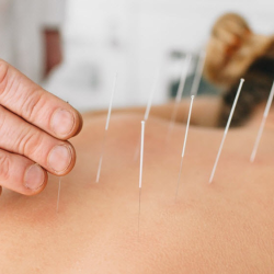 Acupuncture