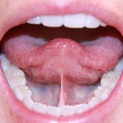 Tongue Ties