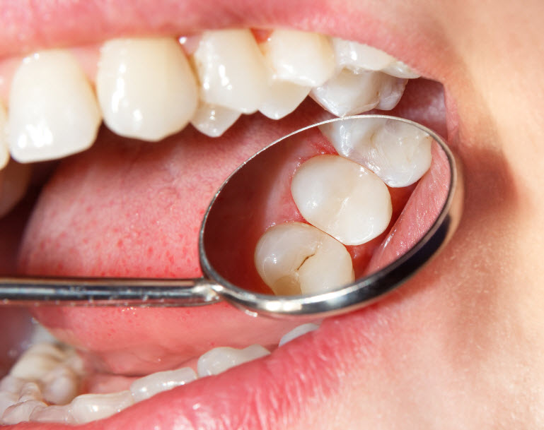 Sealants