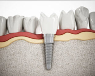 Dental Implants