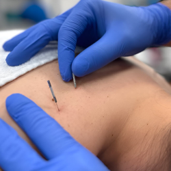 Dry Needling