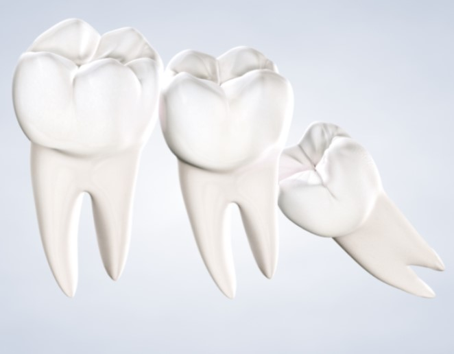 Wisdom Teeth Removal