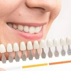 Teeth Whitening