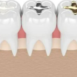 Fillings