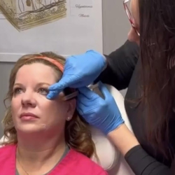 Fillers or Sculptra