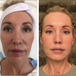Facial Threads