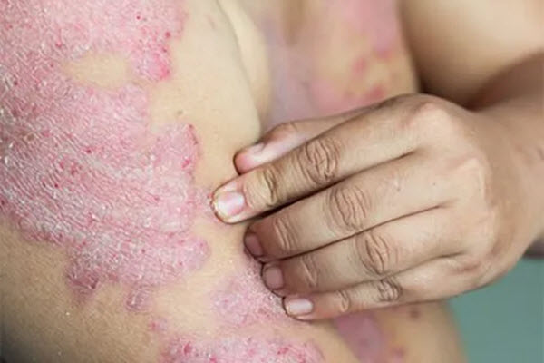 Eczema