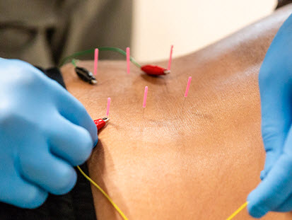 Dry Needling