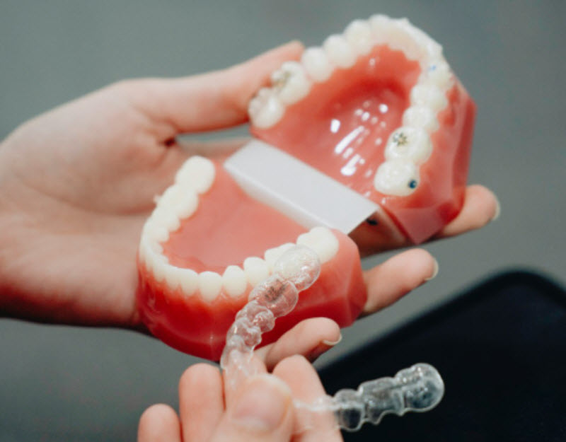 Clear Aligners