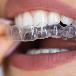 Invisalign Treatment