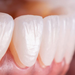 Porcelain Veneers