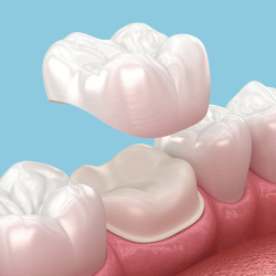 Dental Crowns