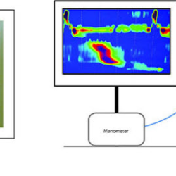 Esophageal Manometry Study