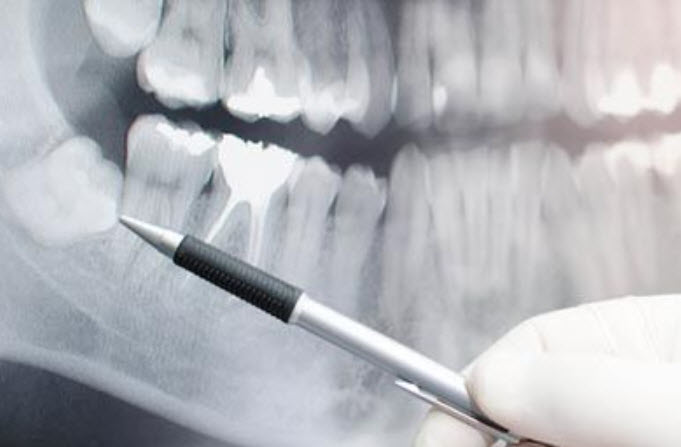 Wisdom Tooth Removal