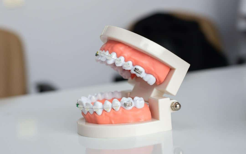 Braces