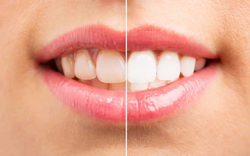 Whitening