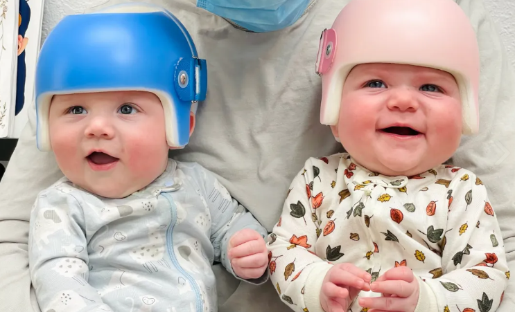 Plagiocephaly