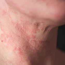 Eczema (Atopic Dermatitis)