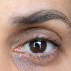 Dark Eye Circles