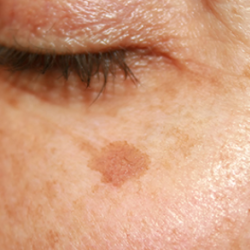 Brown Spots and Discoloration