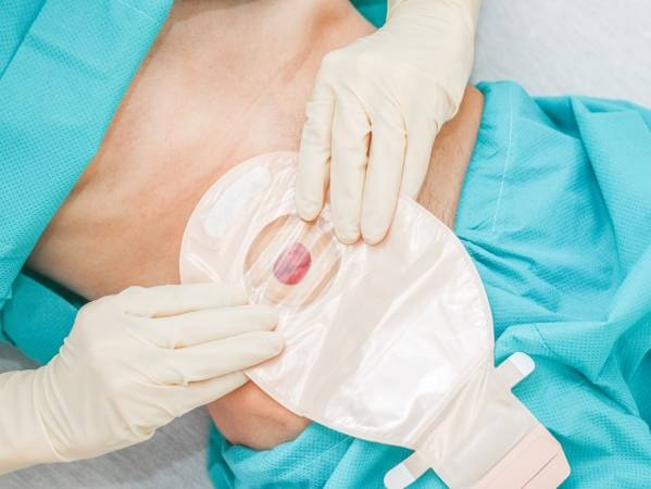 Ostomy