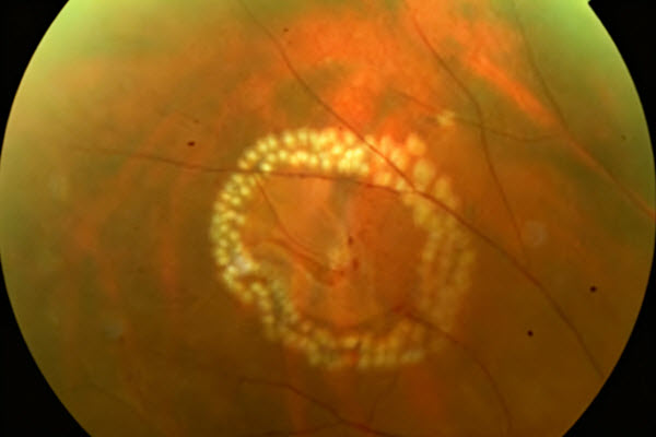 Laser Procedures