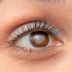Cataracts