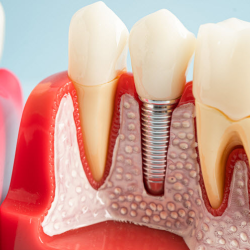 Dental Implants