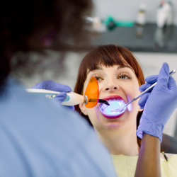 Dental Sealants